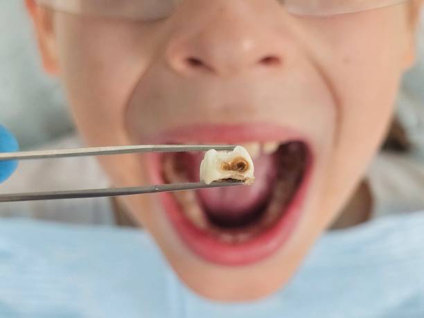 Best Emergency Tooth Extraction in Antwerp, OH